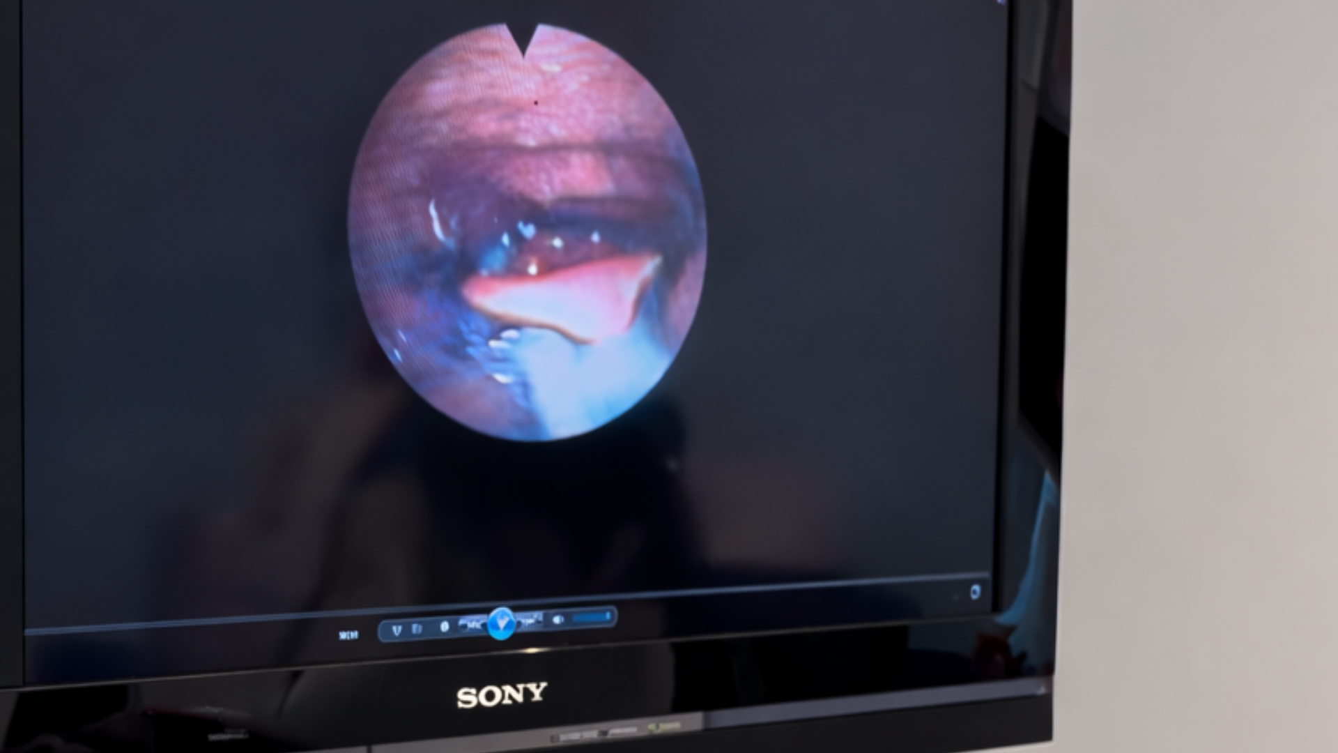 Avaliação Endoscópica da Deglutição (VED): Diagnóstico Essencial para Disfagia.