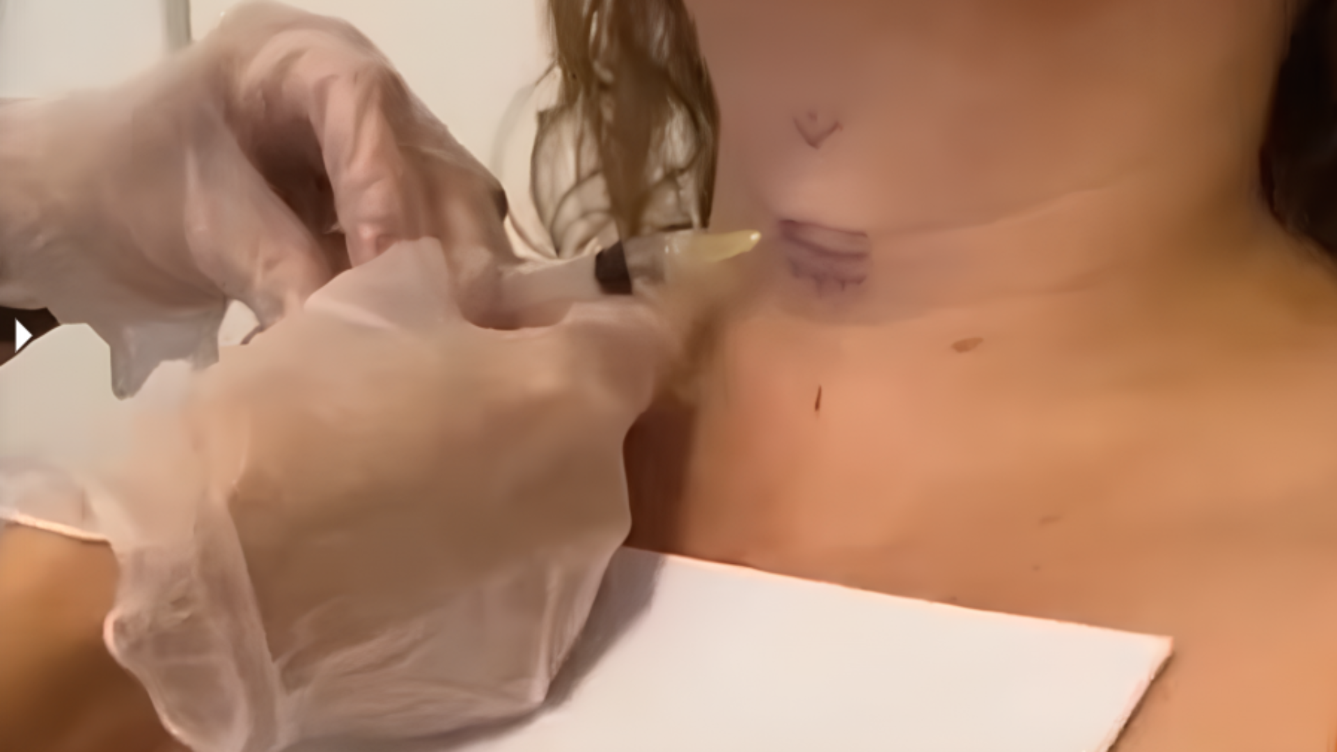 Preenchimento de Pregas Vocais com Ácido Hialurônico: Benefícios e Indicações